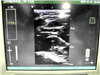 Bard Ultrasound Site-Rite 6 954336